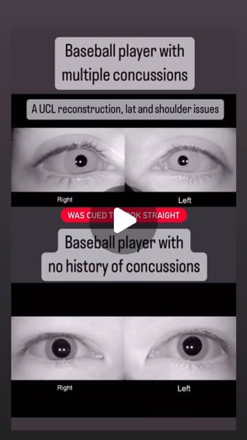 Two athletes' eyes in VNG goggles, one with a history of concussions and one without