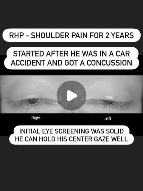 A right-handed pitcher's eyes in VNG goggles during a screening
